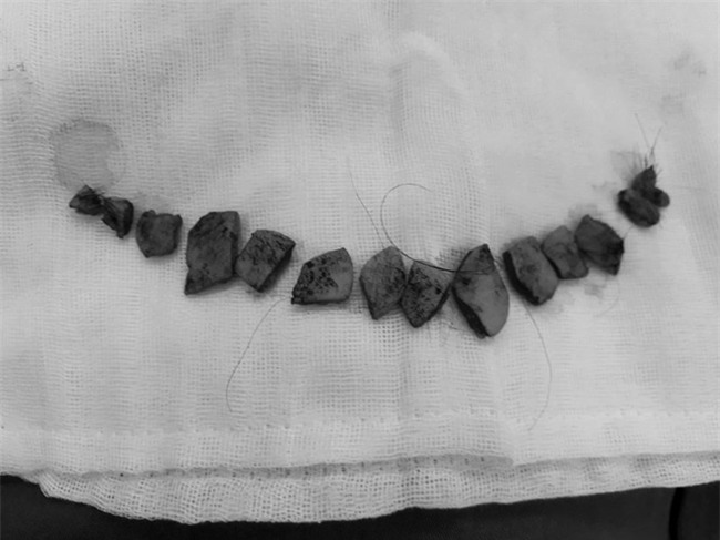 Cô gái làm đẹp bằng cách cắt da đầu để sửa trán cao gây sốc - Ảnh 3.