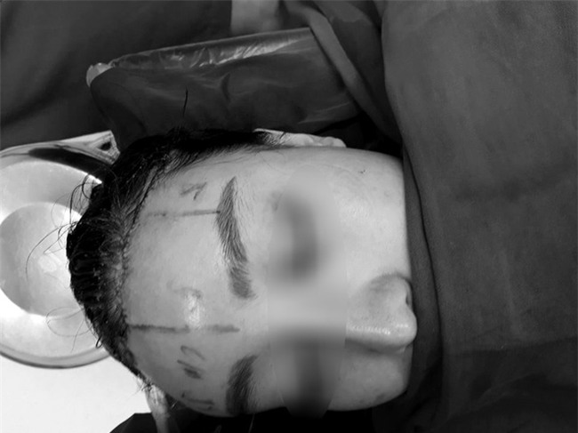 Cô gái làm đẹp bằng cách cắt da đầu để sửa trán cao gây sốc - Ảnh 4.