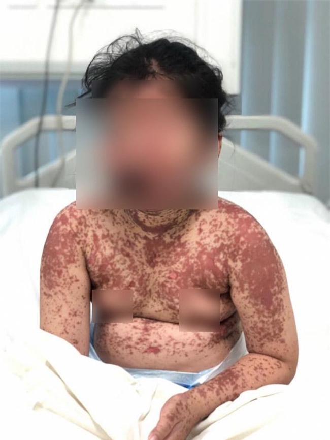 be gai bong bong nang toan than sau khi uong thuoc tai phong kham tu - 1