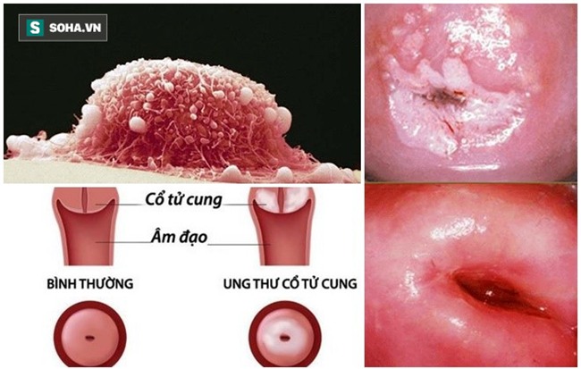 Thủ phạm khiến 7 phụ nữ Việt tử vong mỗi ngày, chị em cần làm ngay điều này để phòng tránh - Ảnh 1.