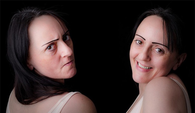 Cẩn trọng với hội chứng rối loạn lưỡng cực như người đẹp Nam Em mắc phải để tránh nguy cơ tự tử - Ảnh 3.