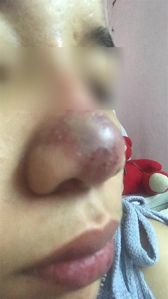 Trải nghiệm kinh hoàng của cô gái suýt hỏng mũi vì tiêm filler, mới 2 ngày đã sưng mọng, mưng mủ trắng kín đầu mũi - Ảnh 2.