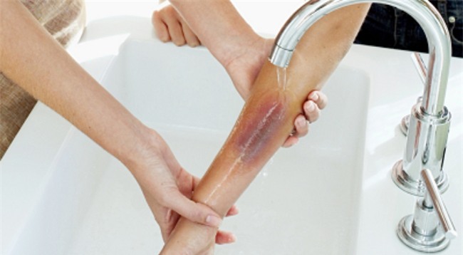 Cần sơ cứu vết bỏng&nbsp;kịp thời và đúng cách để nạn nhân thoát khỏi nguy hiểm (Ảnh minh họa)