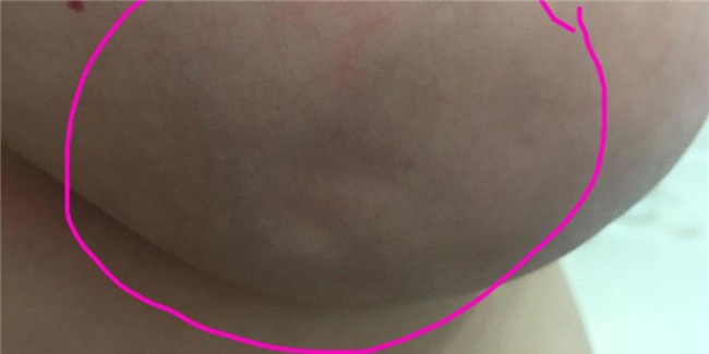 lum dong tien tren nguc: coi chung ung thu vu - 1