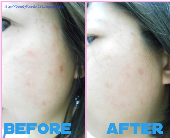 Nàng nào đang khốn khổ vì mụn, chớ bỏ qua loạt đồ dược mỹ phẩm được bác sĩ da liễu tin dùng này - Ảnh 13.