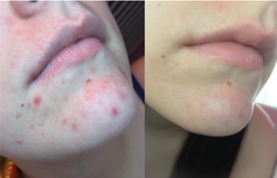 Nàng nào đang khốn khổ vì mụn, chớ bỏ qua loạt đồ dược mỹ phẩm được bác sĩ da liễu tin dùng này - Ảnh 9.