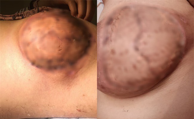 Trải nghiệm kinh hoàng của người mẹ thập tử nhất sinh vì chữa tắc sữa bằng phương pháp dân gian - Ảnh 5.