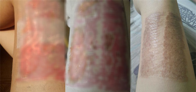 Trải nghiệm kinh hoàng của người mẹ thập tử nhất sinh vì chữa tắc sữa bằng phương pháp dân gian - Ảnh 6.