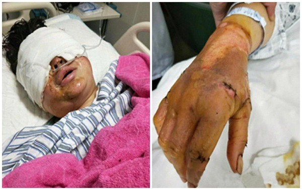 Phẫn nộ người phụ nữ bị biến dạng hoàn toàn sau khi bị chồng cũ trả thù tàn độc - Ảnh 2.