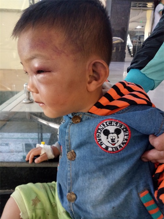 Tạm giữ bố dượng đánh con riêng 2 tuổi của vợ đến mức phải nhập viện