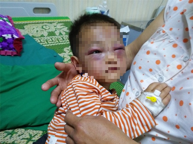 Xót cảnh bé trai 2 tuổi đẻ ra không biết mặt cha, đến khi mẹ lấy chồng thì bị cha dượng đánh đập phải nhập viện cấp cứu - Ảnh 1.