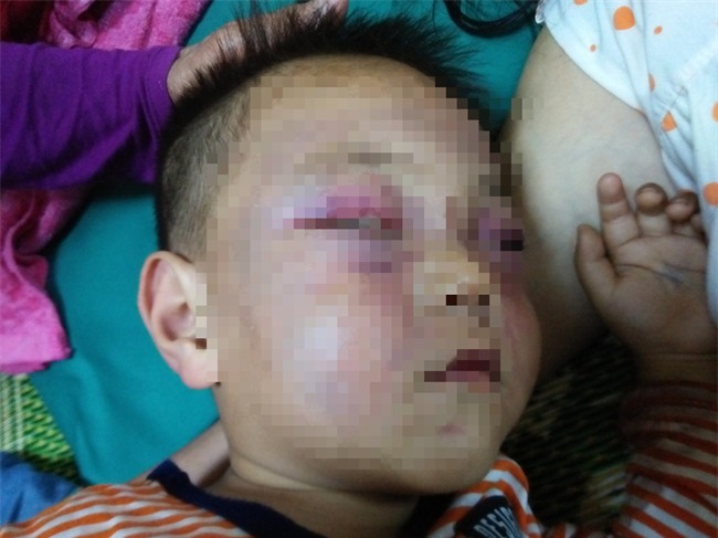 Xót cảnh bé trai 2 tuổi đẻ ra không biết mặt cha, đến khi mẹ lấy chồng thì bị cha dượng đánh đập phải nhập viện cấp cứu - Ảnh 6.