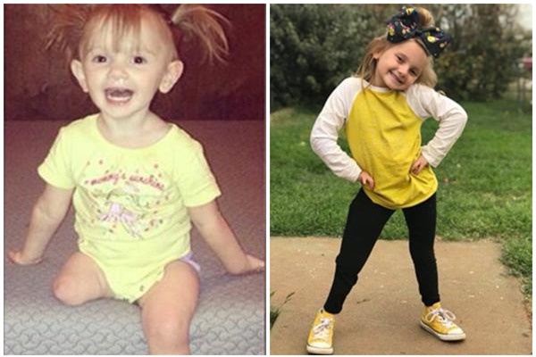 quyet dinh cat bo chan bi di tat bam sinh cua con, me tre da thay doi cuoc doi be - 1