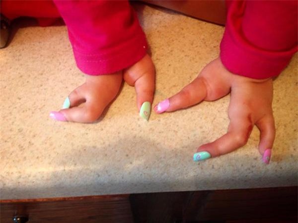 quyet dinh cat bo chan bi di tat bam sinh cua con, me tre da thay doi cuoc doi be - 2