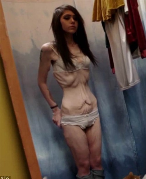 Hậu giảm cân, cô gái bị trầm cảm nặng vì làn da chảy xệ - Ảnh 2.