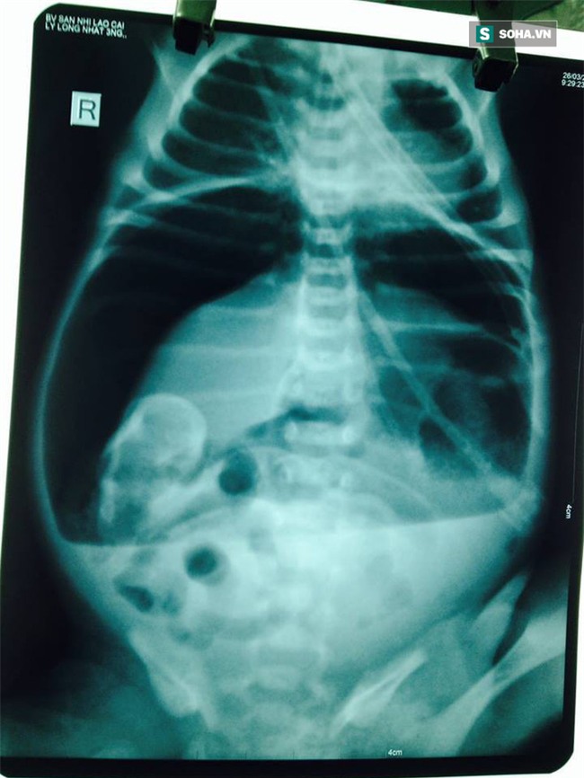 Hiếm gặp: Cháu bé sơ sinh 2 ngày tuổi ở Lào Cai bị vỡ dạ dày - Ảnh 1.