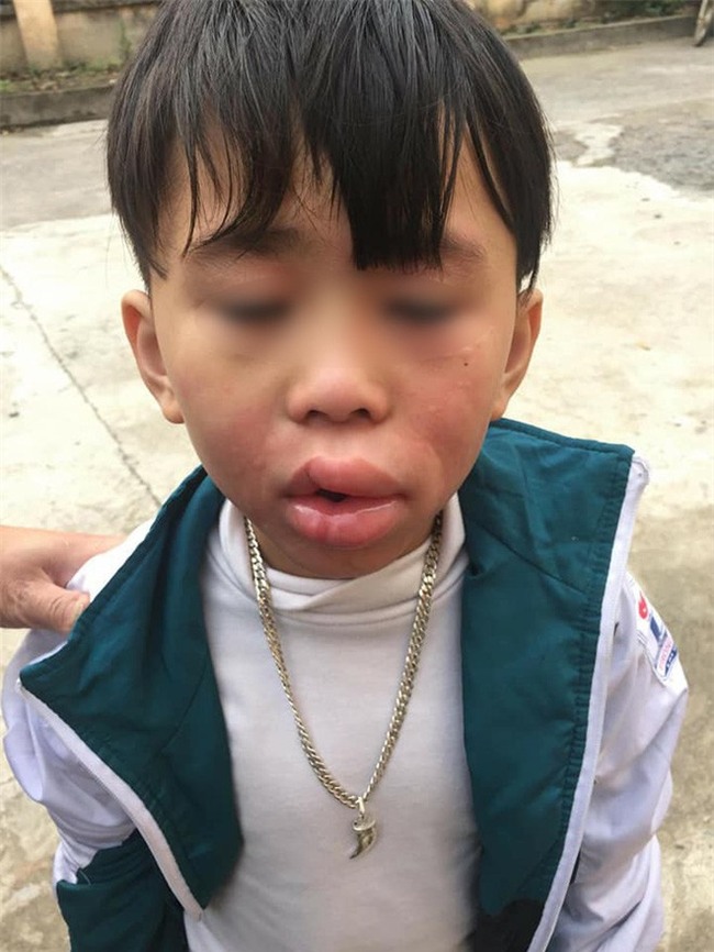 Hoang mang thông tin bé trai sưng húp môi sau khi ăn kẹo dẻo ở cổng trường - Ảnh 2.