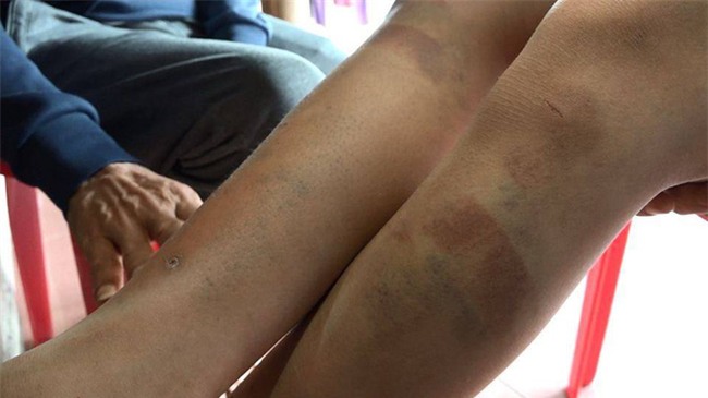 Hà Nội: Bố đẻ cùng mẹ kế đánh đập bé trai 14 tuổi bầm tím khắp cơ thể