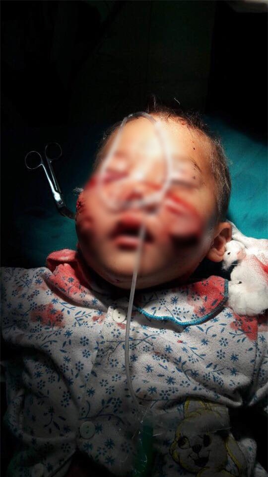 Bé 29 tháng tuổi bị chó cắn rách mặt và những quy tắc an toàn cho con bố mẹ phải nhớ - Ảnh 1.