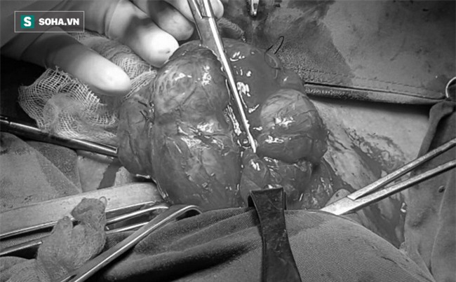 Cụ bà bị bướu cổ nặng nửa ký, phải ngủ ngồi suốt nhiều năm suýt mất mạng vì biến chứng-1