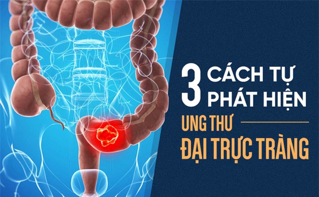 Ung thư đại trực tràng: Phát hiện sớm 3 tháng, có thể sống thêm 30 năm-1
