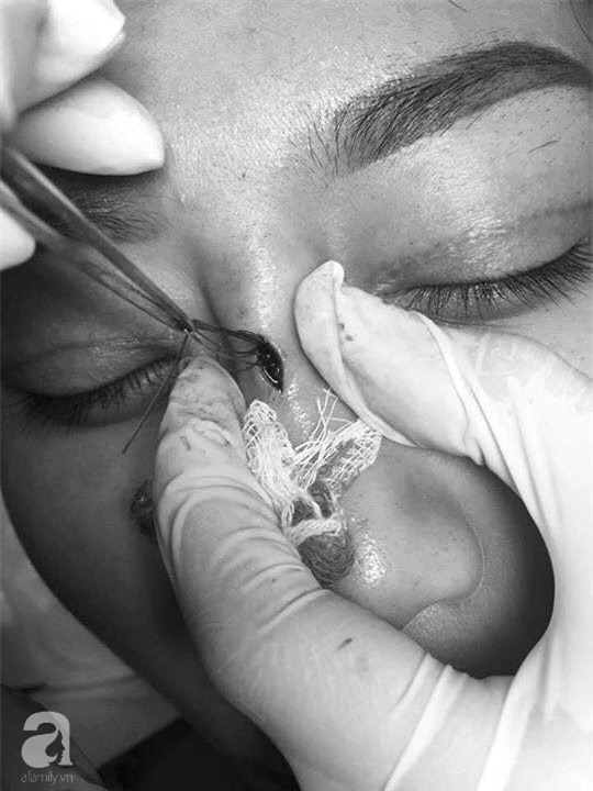 Cô gái 22 tuổi ở Bạc Liêu bị hủy hoại dung nhan vì đi nâng mũi bằng chỉ