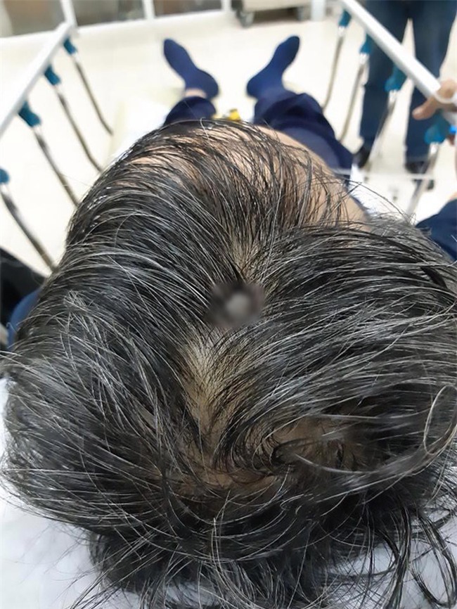 Báo Anh đưa tin bệnh nhân Việt không chịu đi khám dù đinh 8 cm xuyên vào đầu - Ảnh 1.