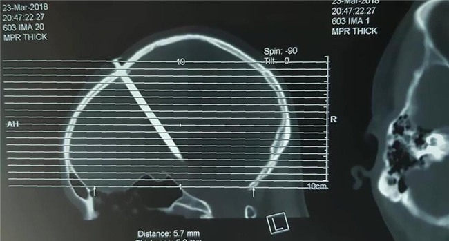 Báo Anh đưa tin bệnh nhân Việt không chịu đi khám dù đinh 8 cm xuyên vào đầu - Ảnh 2.