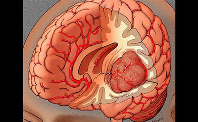 Dấu hiệu U não - 1 trong 10 bệnh ung thư gây tử vong hàng đầu-1