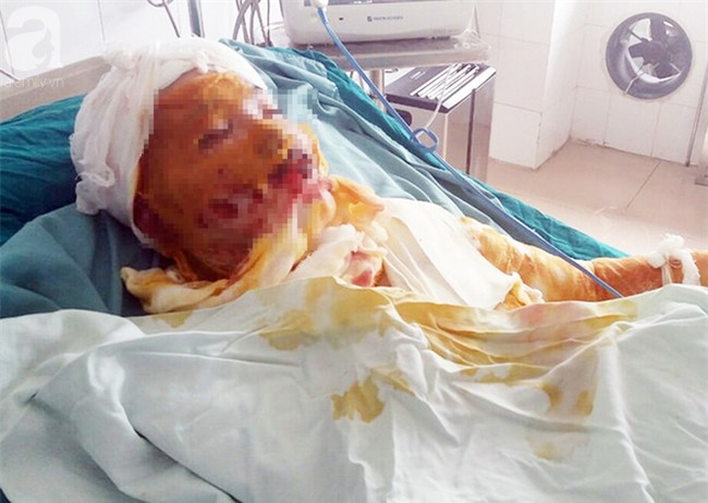Hoàn cảnh bi đát của cô gái trẻ lao vào cứu bạn trong vụ bị người tình tẩm xăng thiêu sống - Ảnh 3.