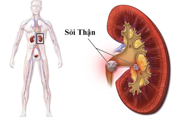 Bệnh nhân mổ sỏi thận 6 lần vẫn tái phát, bác sĩ