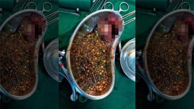 bac si soc khi phau thuat gap 2.350 vien soi mat trong co the nguoi phu nu - 2