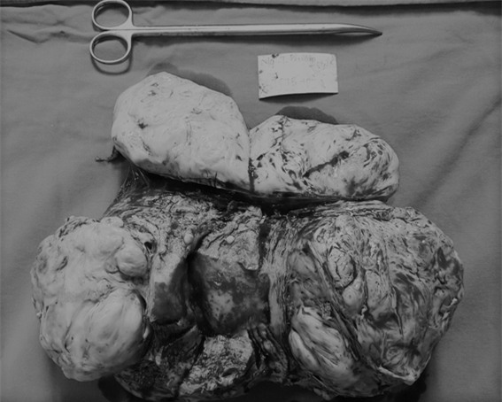 Phát hiện khối u khổng lồ sau những cơn đau bụng-1