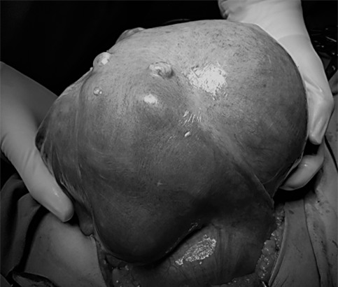Phát hiện khối u khổng lồ sau những cơn đau bụng-2
