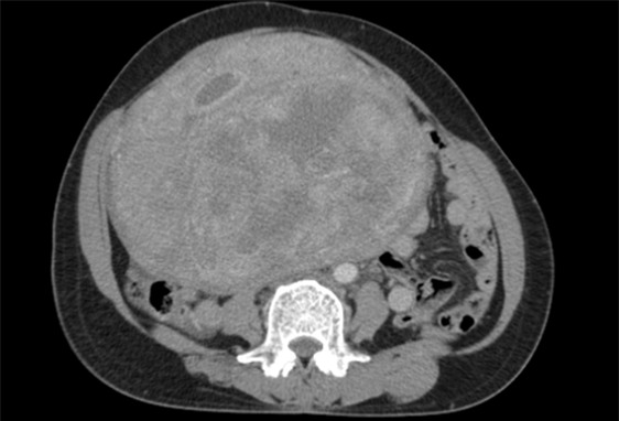 Phát hiện khối u khổng lồ sau những cơn đau bụng-3