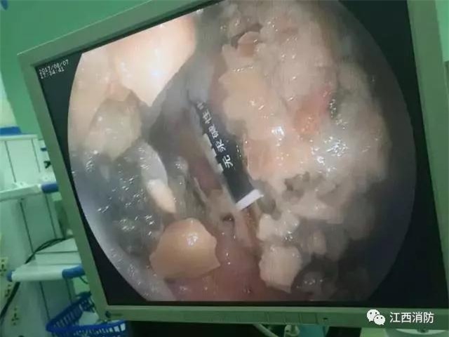 be gai 8 tuoi nuot cuc pin vao bung, hanh dong cua ba noi suyt lam chau mat mang - 1