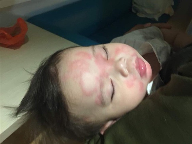 Cậu bé bị nổi ban đỏ, nôn mửa và tiêu chảy nghiêm trọng do uống sữa công thức giả-1