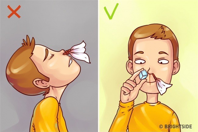 Để chảy máu cam chấm dứt không phải ngửa đầu ra sau, đây mới là cách sơ cứu đúng!-4