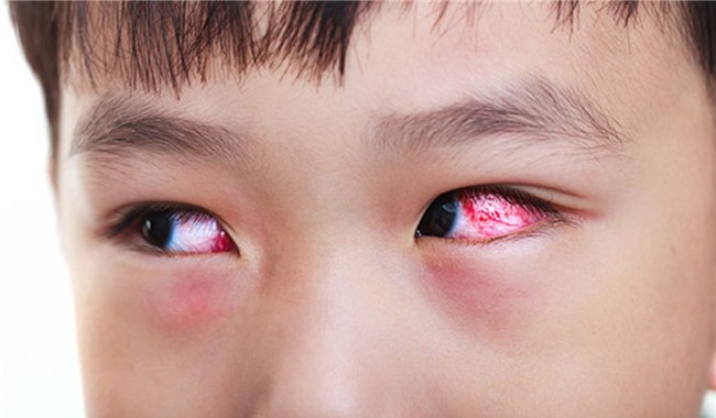 Những bài thuốc y học cổ truyền chữa đau mắt đỏ-1