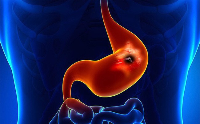 4 nhóm người có tỉ lệ bị ung thư dạ dày cao-3