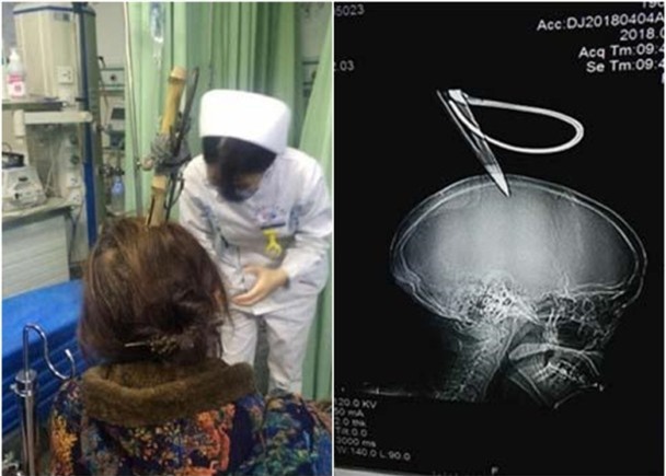 Người phụ nữ thoát chết trong gang tấc sau khi bị kéo rơi trúng đầu - Ảnh 1.