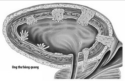 Ung thư bàng quang phát hiện sớm, điều trị nhanh-1