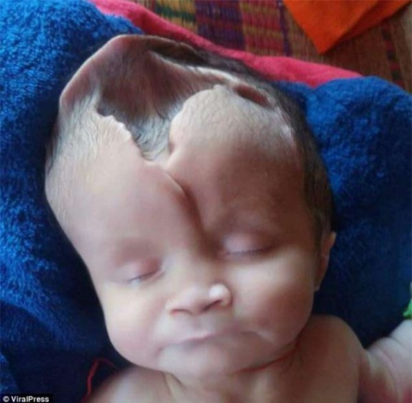 Bé gái 2 tháng tuổi bị khuyết não và hộp sọ bẩm sinh chống chọi tử thần từng giây - Ảnh 1.