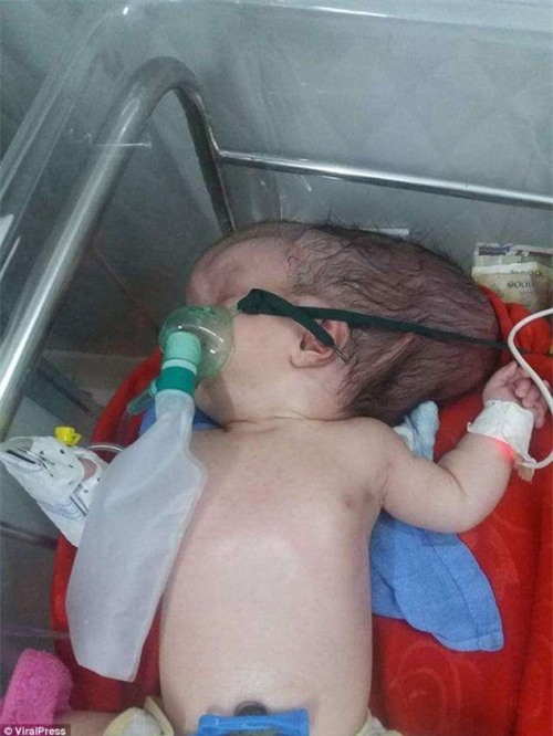 Bé gái 2 tháng tuổi bị khuyết não và hộp sọ bẩm sinh chống chọi tử thần từng giây - Ảnh 3.