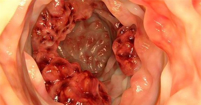 Bé 10 tuổi bị ung thư đại trực tràng giai đoạn cuối-1