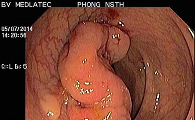 Bé 10 tuổi bị ung thư đại trực tràng giai đoạn cuối-2