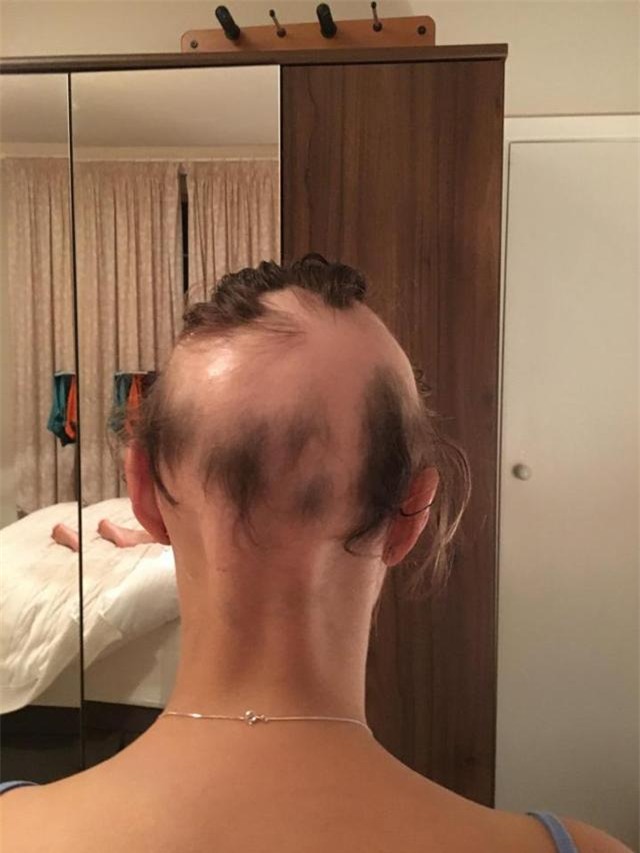 nguoi phu nu bi rung toc kinh hoang, dau trang tron chi vi qua lo lang cho dam cuoi - 2