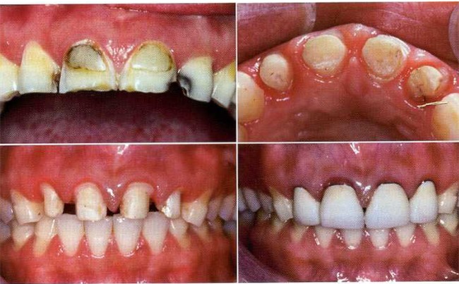 Bác sĩ BV Răng hàm mặt chỉ rõ 3 biến chứng đáng sợ của răng sứ thẩm mỹ-1