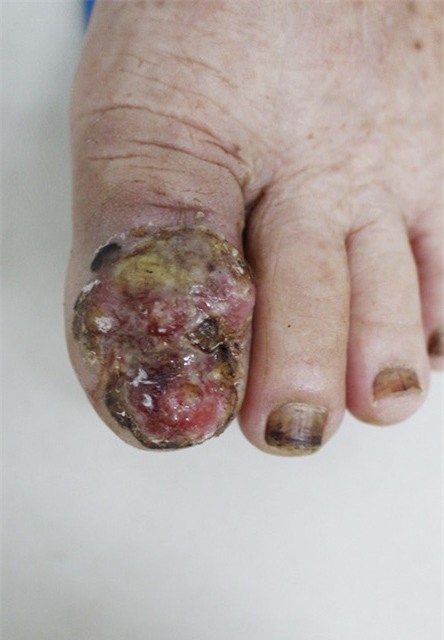 Cảnh báo gia tăng bệnh nhân ung thư da, nhiều người không biết mình mắc bệnh-2