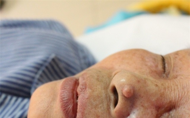 Cảnh báo gia tăng bệnh nhân ung thư da, nhiều người không biết mình mắc bệnh-3